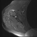 Avulsion fracture - greater tuberosity of humerus (Radiopaedia 71216-81515 Axial PD fat sat 4).jpg