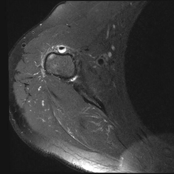 File:Avulsion fracture - greater tuberosity of humerus (Radiopaedia 71216-81515 Axial PD fat sat 4).jpg