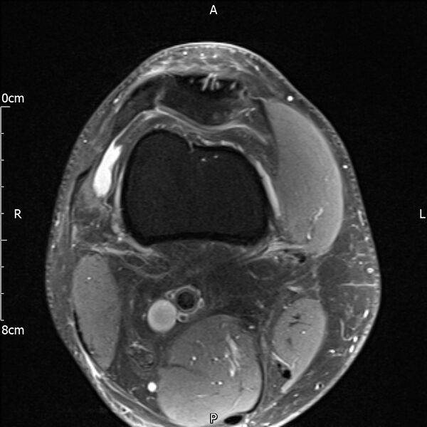 File:Avulsion fracture of the fibular head (Radiopaedia 74804-85808 Axial PD fat sat 4).jpg