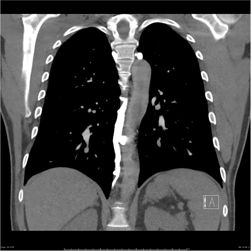 Azygos venous system anatomy (CT pulmonary angiography) (Radiopaedia 25928-26077 Coronal C+ CTPA 52).jpg