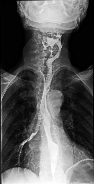 File:Barium swallow aspiration (Radiopaedia 71621-81993 G 1).jpg