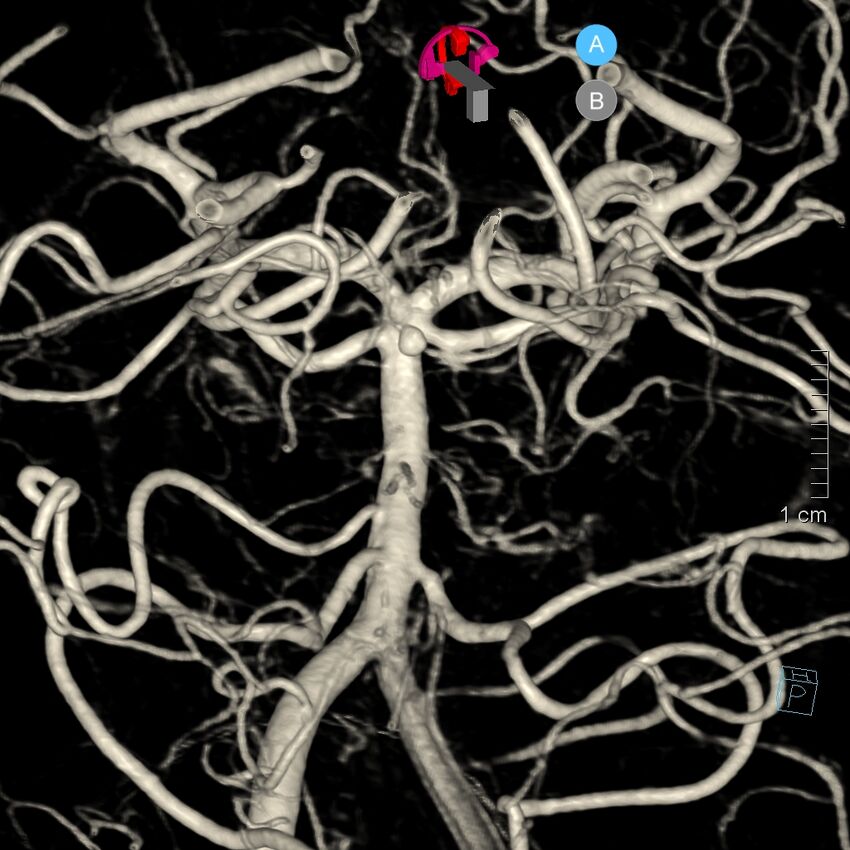 Basilar artery perforator aneurysm (Radiopaedia 82455-97734 3D view left VA 88).jpg