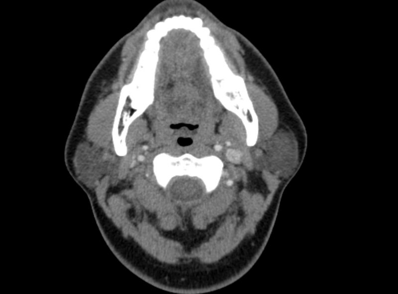 File:Benign mixed salivary tumor of the parotid gland (Radiopaedia 35261-36792 A 20).jpg