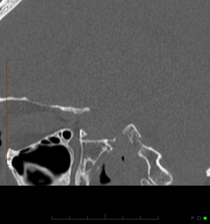 Benign notochordal cell tumor (probable) (Radiopaedia 65475-74546 Sagittal bone window 42).jpg