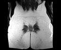 Bicornuate bicollis uterus (Radiopaedia 61626-69616 Coronal T2 35).jpg