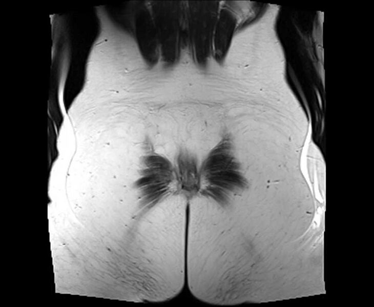 File:Bicornuate bicollis uterus (Radiopaedia 61626-69616 Coronal T2 35).jpg