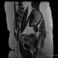 Bicornuate uterus- on MRI (Radiopaedia 49206-54297 Sagittal T2 2).jpg