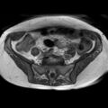 Bicornuate uterus (Radiopaedia 61974-70046 Axial T1 16).jpg