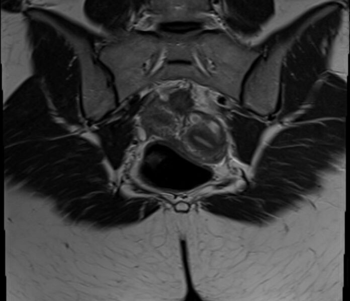 File:Bicornuate uterus (Radiopaedia 71214-81511 Coronal T2 6).jpg