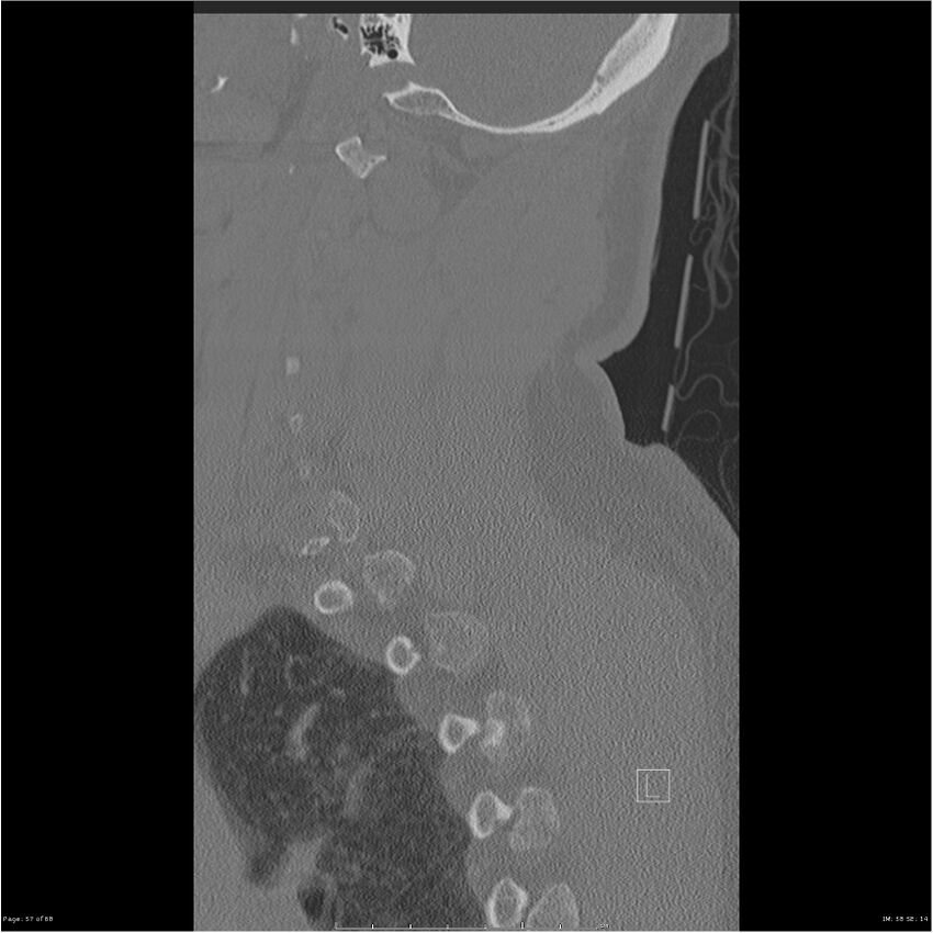Bilateral cervical ribs (Radiopaedia 25868-26017 Sagittal bone window 57).jpg