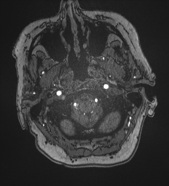 File:Bilateral fetal posterior communicating arteries (Radiopaedia 41286-44102 Axial MRA 1).png