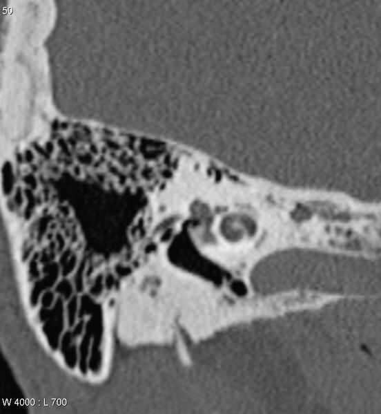 File:Bilateral otosclerosis with left stapes prosthesis (Radiopaedia 5567-7302 Coronal bone window 7).jpg