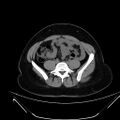 Bilateral ovarian mature cystic teratomas (Radiopaedia 79373-92457 Axial non-contrast 36).jpg