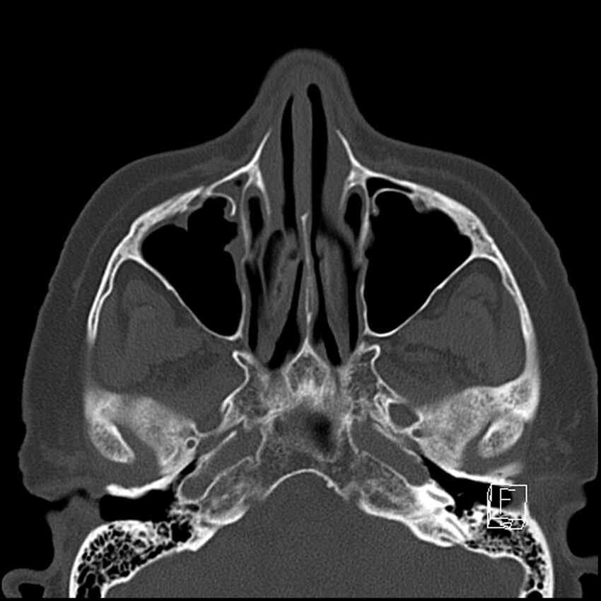 Bilateral palatine tonsilloliths on OPG and CT (Radiopaedia 75167-86247 Axial bone window 19).jpg