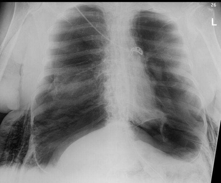 File:Bilateral pneumothorax (Radiopaedia 83512).jpg