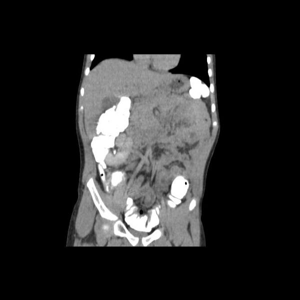 File:Bilateral renal malrotation (Radiopaedia 30901-31606 Coronal C+ delayed 6).jpg