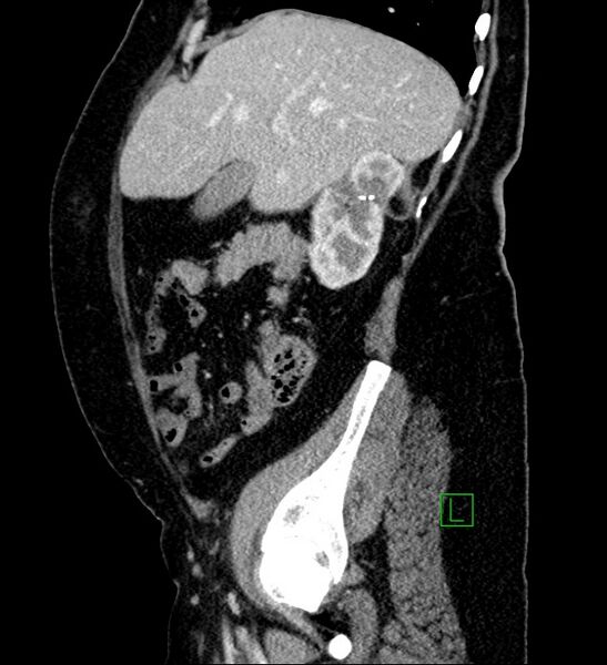 File:Bilateral sporadic synchronous clear cell renal cell carcinoma (Radiopaedia 85035-100575 G 83).jpg