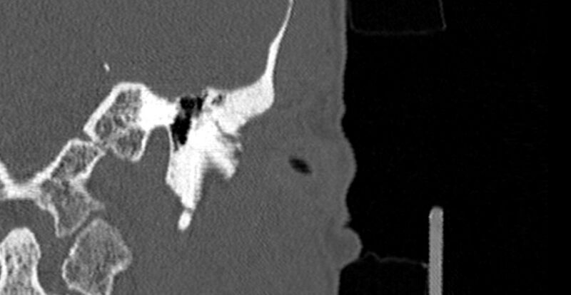 File:Bilateral temporal bone fractures (Radiopaedia 29482-29970 Coronal 271).jpg