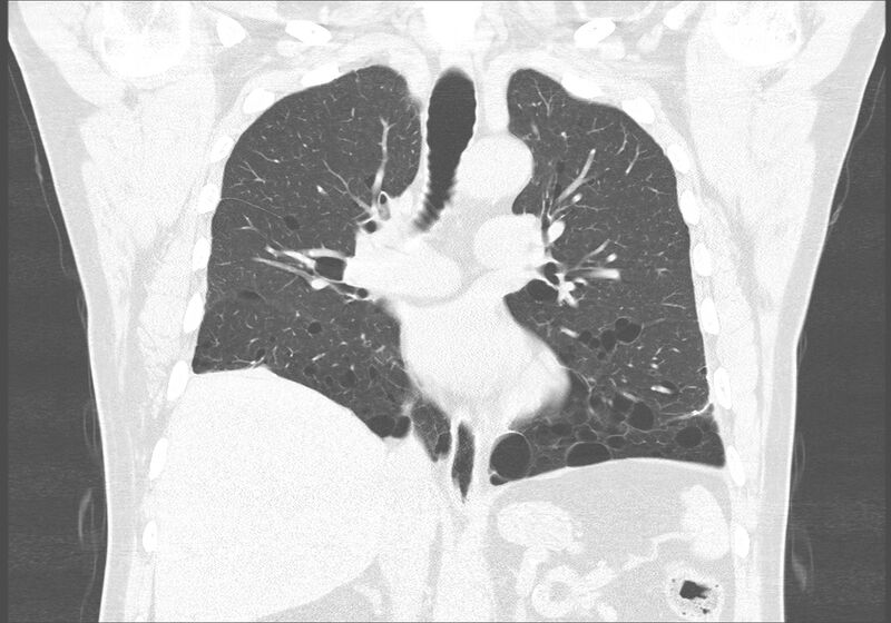 File:Birt-Hogg-Dubé syndrome (Radiopaedia 52578-58491 Coronal lung window 29).jpg