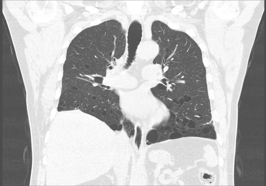 Birt-Hogg-Dubé syndrome (Radiopaedia 52578-58491 Coronal lung window 29).jpg