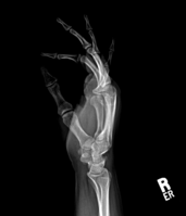 X-ray hand, BPOP 2nd metacarpal (side view)
