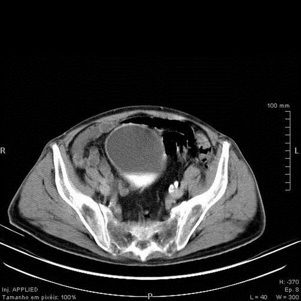 File:Bladder squamous cell carcinoma (Radiopaedia 14130-13984 C 3).jpg