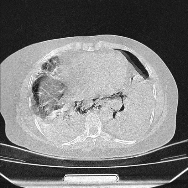 File:Boerhaave syndrome (Radiopaedia 45644-49799 Axial lung window 81).jpg
