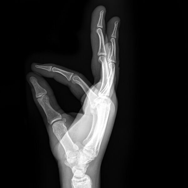 File:Boxer fracture (Radiopaedia 7544-8362 Lateral 1).jpg