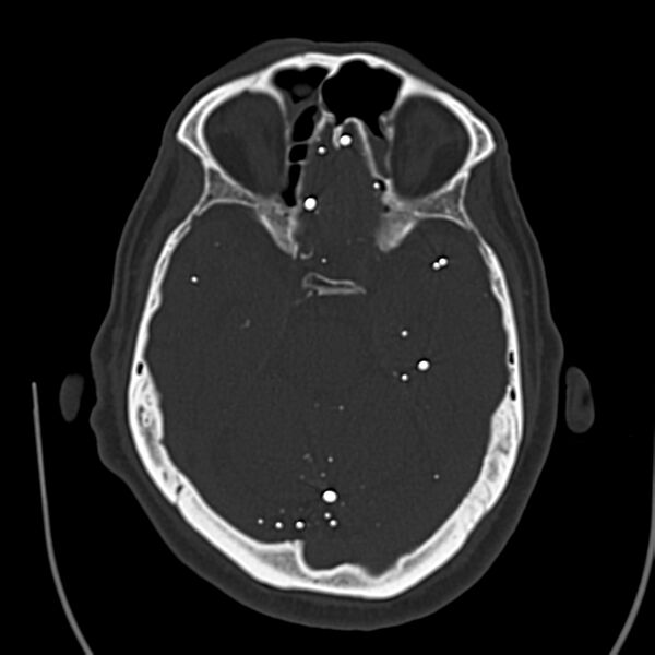 File:Brain Pantopaque remnants (Radiopaedia 78403-91048 Axial bone window 29).jpg