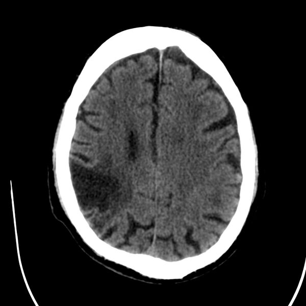 File:Brain Pantopaque remnants (Radiopaedia 78403-91048 Axial non-contrast 63).jpg
