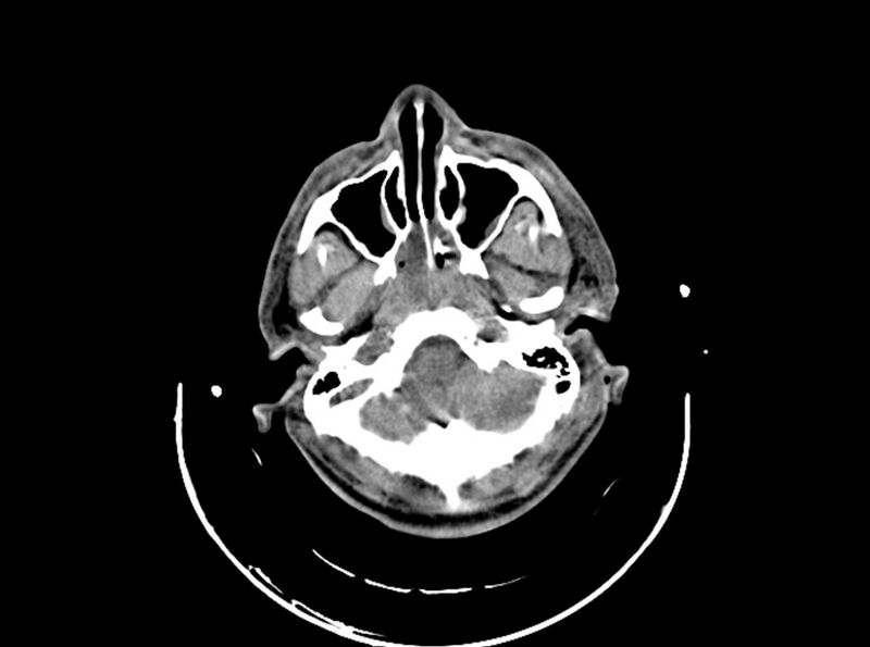 File:Brain injury by firearm projectile (Radiopaedia 82068-96087 B 50).jpg