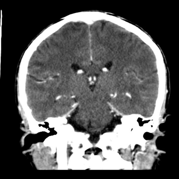 File:Brain metastases from lung cancer (Radiopaedia 24480-24781 Coronal C+ delayed 37).jpg