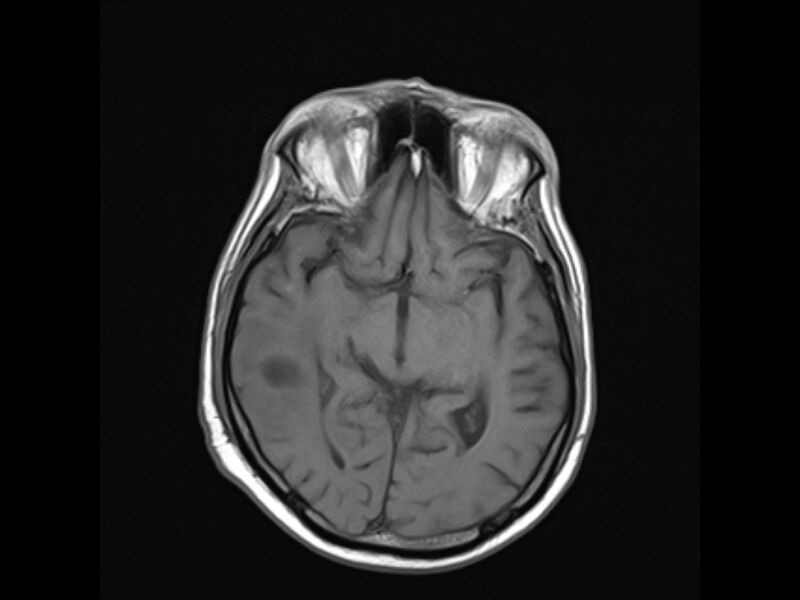 File:Brain metastases from renal cell carcinoma (Radiopaedia 42222-45297 Axial T1 12).jpg