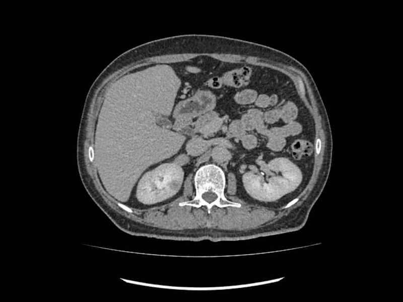 File:Brain metastases from renal cell carcinoma (Radiopaedia 42222-45328 Axial C+ delayed 62).jpg