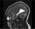 Brainstem glioma (Radiopaedia 21819-21775 Sagittal T2 5).jpg