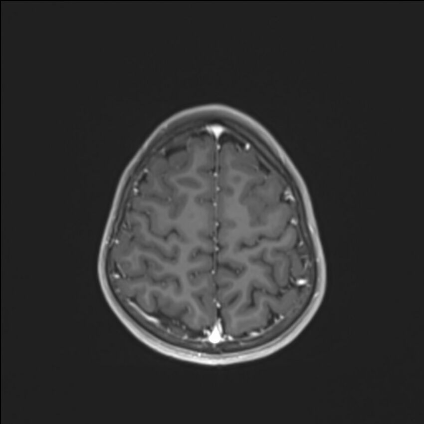 Brainstem glioma (Radiopaedia 70548-80674 Axial T1 C+ 128).jpg