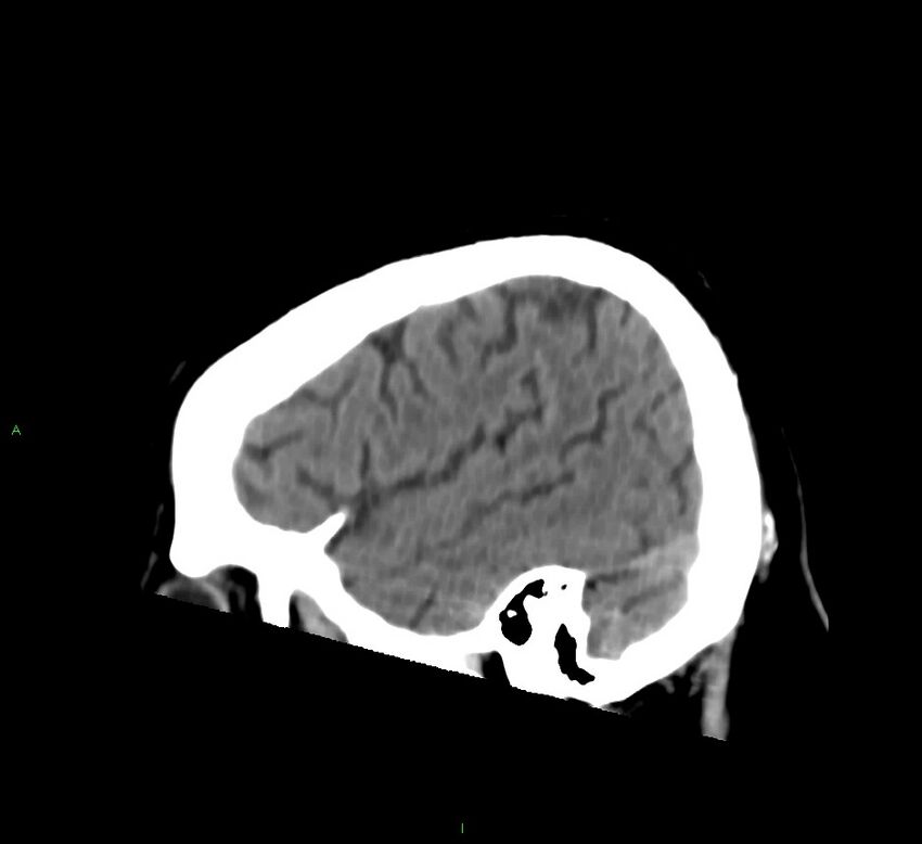Brainstem hemorrhage (Radiopaedia 58794-66028 C 10).jpg