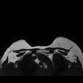 Breast implants - MRI (Radiopaedia 26864-27035 Axial T2 44).jpg