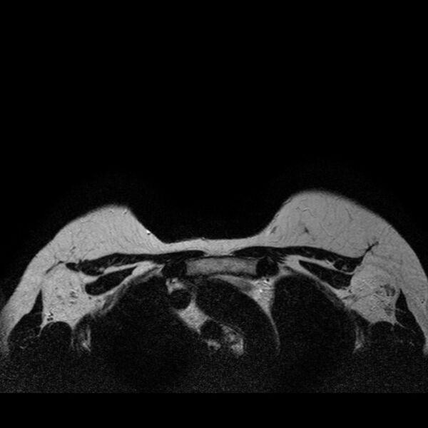 File:Breast implants - MRI (Radiopaedia 26864-27035 Axial T2 44).jpg