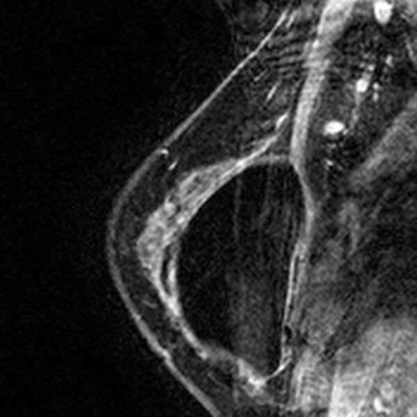 File:Breast implants - MRI (Radiopaedia 26864-27035 Sagittal T2 112).jpg