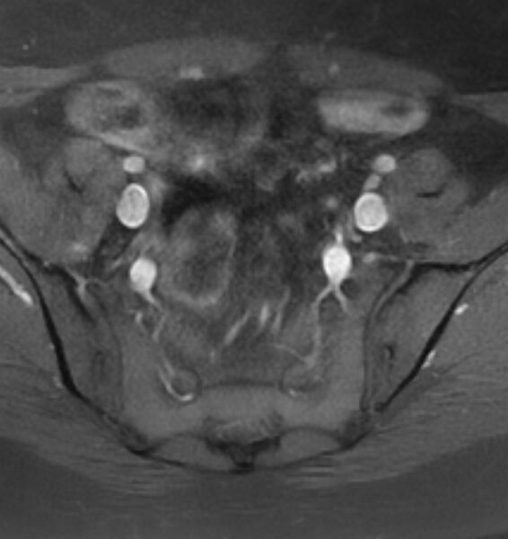 File:Broad ligament leiomyoma (Radiopaedia 81634-95516 Axial T1 C+ fat sat 6).jpg