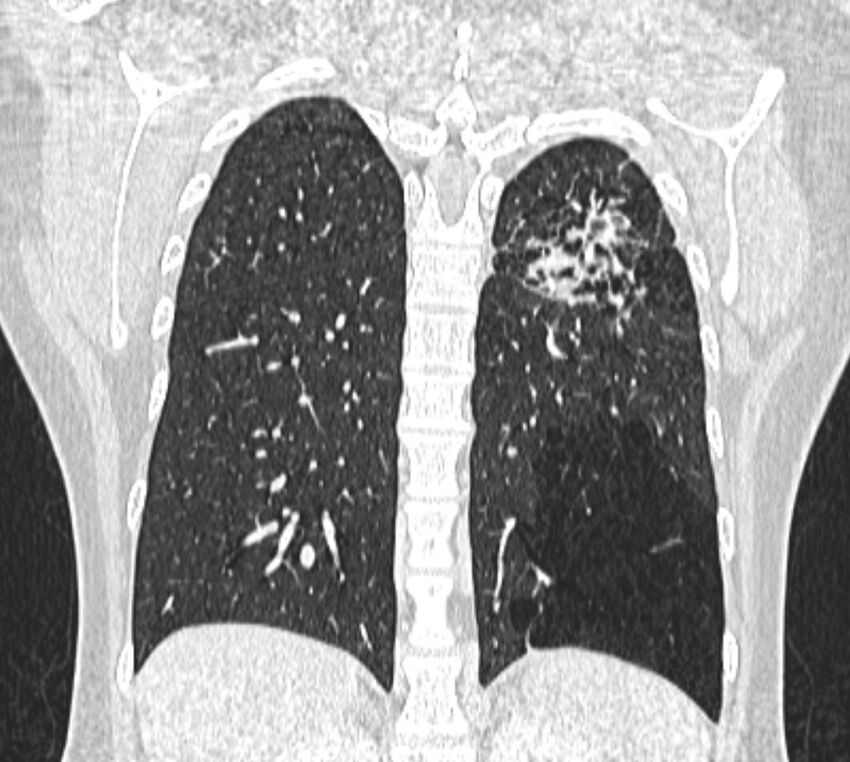 Bronchial atresia (Radiopaedia 50007-55297 Coronal lung window 86).jpg