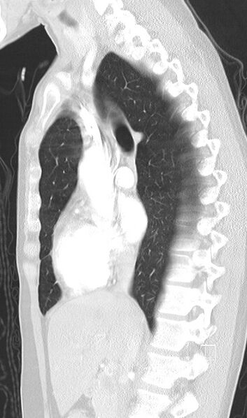 File:Bronchial atresia (Radiopaedia 73677-84470 Sagittal lung window 25).jpg