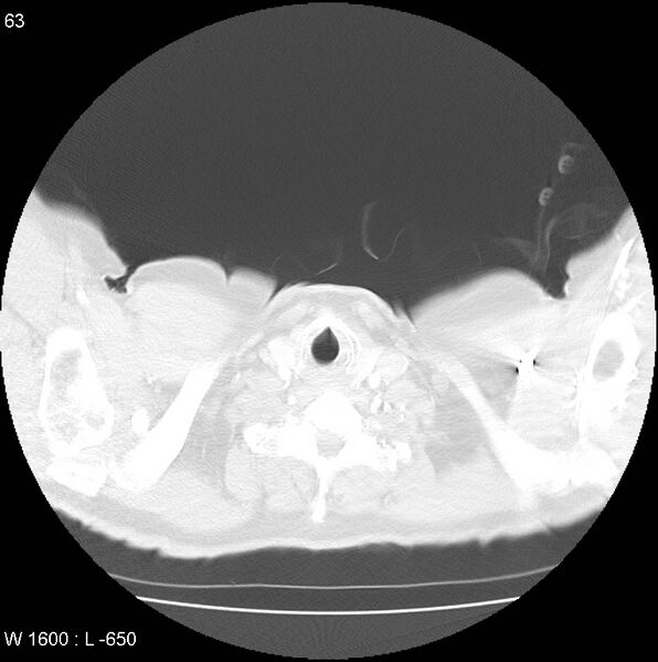 File:Bronchial carcinoid tumor with right lower lobe collapse (Radiopaedia 29060-29422 B 1).jpg