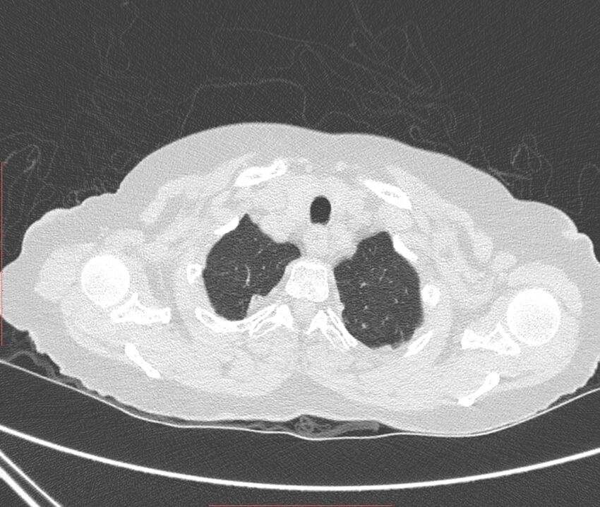 Bronchiectasis (Radiopaedia 72693-83293 Axial lung window 7).jpg