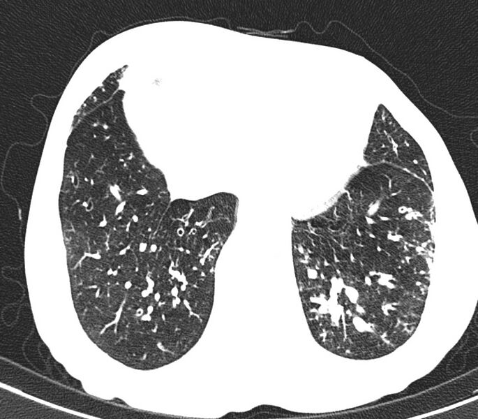 File:Bronchiolitis (Radiopaedia 24616-24887 Axial lung window 48).jpg