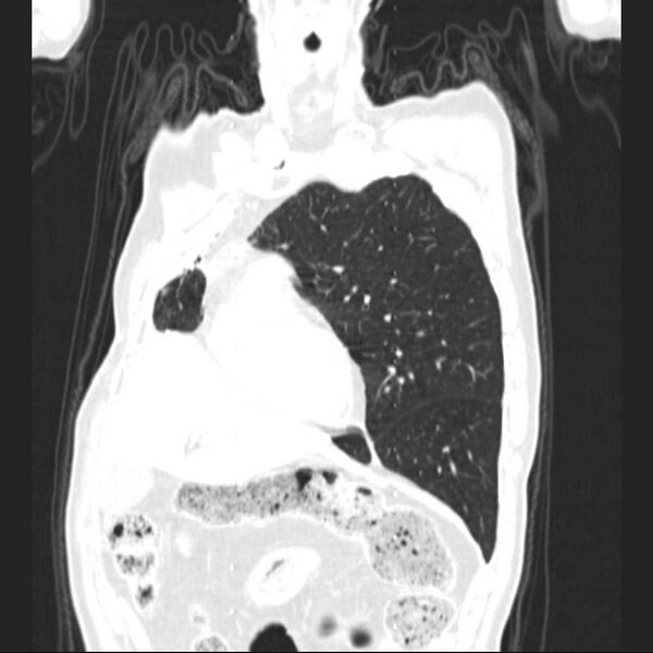 File:Bronchopleural fistula - postoperative complication (Radiopaedia 21020-20947 Coronal lung window 8).jpg