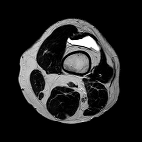 File:Bucket handle tear - medial meniscus (Radiopaedia 29250-29664 Axial T2 22).jpg