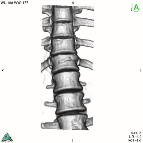 File:Bulging of paraspinal line in traumatic thoracal spinal compression fracture (Radiopaedia 29221-35872 3D VR 10).jpg