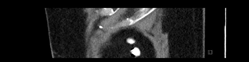 Buried bumper syndrome - gastrostomy tube (Radiopaedia 63843-72575 Sagittal Inject 8).jpg
